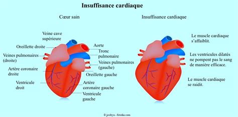 Tout Savoir Sur Linsuffisance Cardiaque