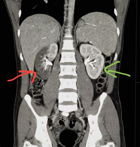 Abdomen Ct Shows Blood Flow Blocked To The Kidney Red Renal