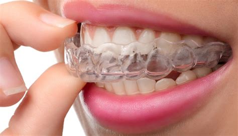 Many dental offices will allow payment plans that let you split the cost of. Occlusal Splints - Prevent Teeth Grinding & Clenching - Dainty Dental Care