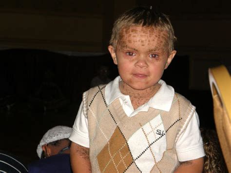 Epidermolytic Ichthyosis 9 Uncommon Skin Conditions Pictures Cbs News