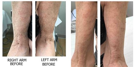 Exilis Ultra Skin Tightening Before And After Photo Gallery Washington Dc Mi Skin Dermatology