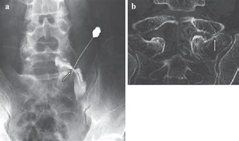 Figure 3 From A Case Of L 5 Radiculopathy Caused By Far Out Syndrome