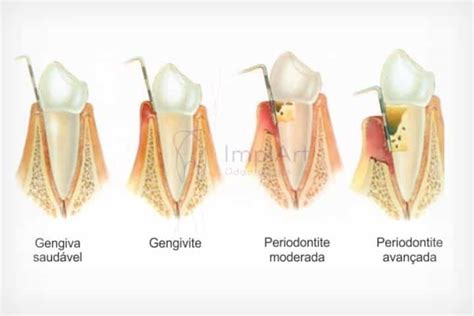 Tratamento para a periodontite doença periodontal