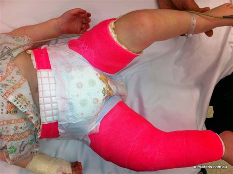 Hip Spica for Fractured Femur in Child Photos