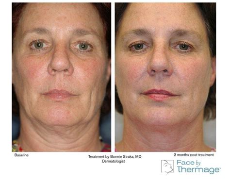 Skin Tightening Thermage Flx Sydney Thermage Experts