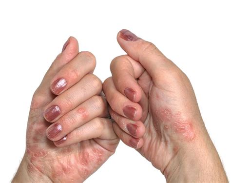 Psoriasis Of The Hands And Feet Symptoms Diagnosis Treatment
