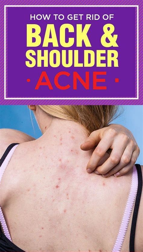 3 Best Remedies For Back Acne Wellness Magazine