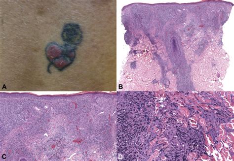 Lichenoid Granulomatous Dermatitis Revisited A Retrospective Case
