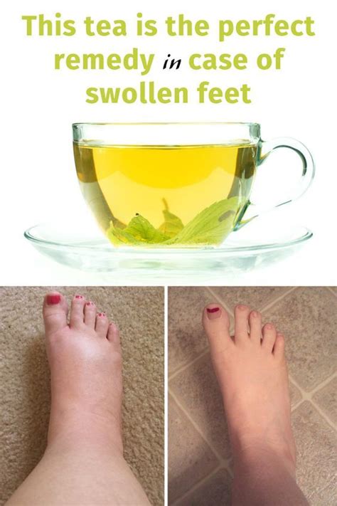 This Tea Is The Perfect Remedy In Case Of Swollen Feet Water Retention Remedies Foot Remedies