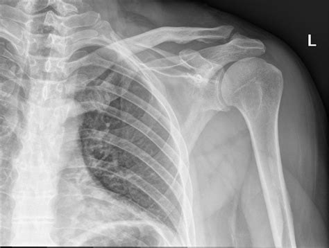 Right Scapula Fracture