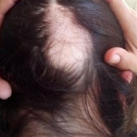 Vitamin D Deficiency Symptoms Experiencing Hair Loss Right Here Are