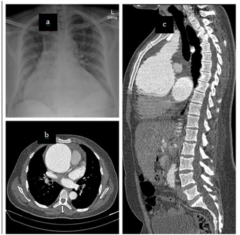 Giant Aortic Aneurysm In A Patient With Marfan Syndrome MedCrave Online