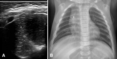 Point Of Care Ultrasound Differentiation Of Lung Consolidation And