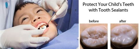 Protect Your Childs Teeth With Tooth Sealants Akron Ohio Moms
