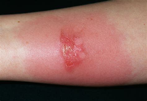 Infected Burn Photograph By Dr P Marazziscience Photo Library