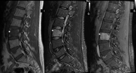 Mri Of The Lumbar Spine December 2018 The Superior Endplate