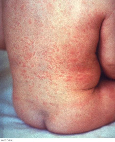 Rubella Symptoms And Causes Mayo Clinic