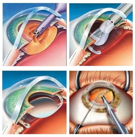 Microincision Cataract Surgery Mics Eyemantra Cataract Eye Surgery
