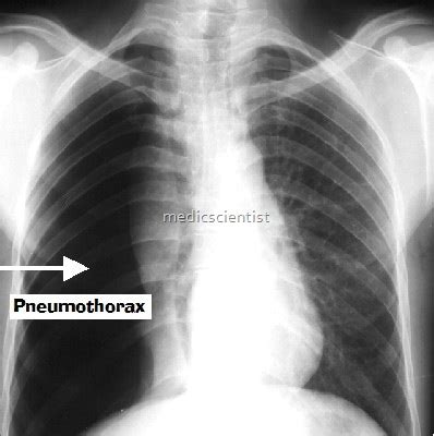 Pneumothorax develops when air enters the pleural space as the result of disease or injury. Pneumothorax Symptoms Causes Diagnosis Treatment with ...