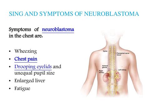 Neuroblastoma Patient Info On Symptoms Diagnosis And Treatment Options