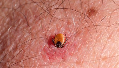 Deer Tick Embedded In Skin By Science Stock Photography