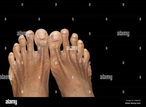 Trench Foot Hi Res Stock Photography And Images Alamy