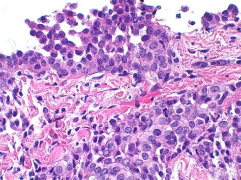 Mesothelioma In Situ Case 298 Invasive Epithelioid Mesot Flickr