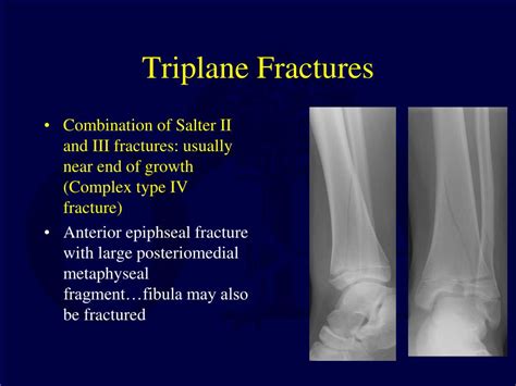 Ppt Pediatric Ankle And Foot Fractures Powerpoint Presentation Id3363563
