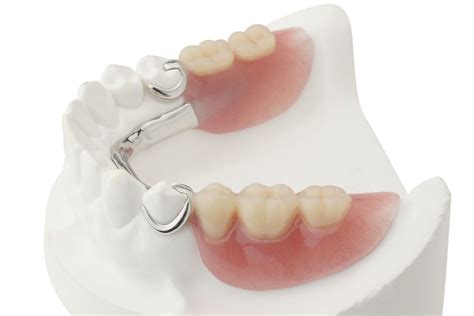 Partial Dentures Replace One Or More Missing Teeth