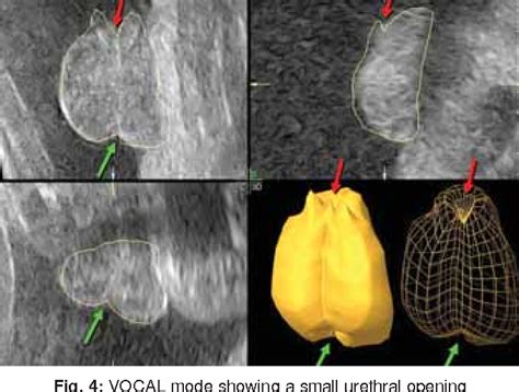 3d Vocal And Tomographic Ultrasound Imagein Prenatal Diagnosis Of