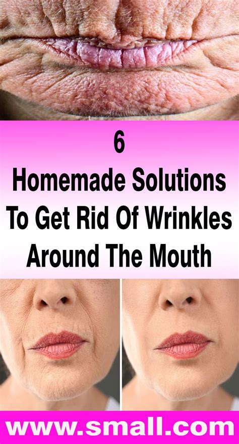 6 Homemade Solutions To Get Rid Of Wrinkles Around The Mouth