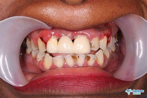 Ursachen für das loch im zahn. Loch im Zahn: Behandlung ohne Schmerzen? | Centrocc Dental