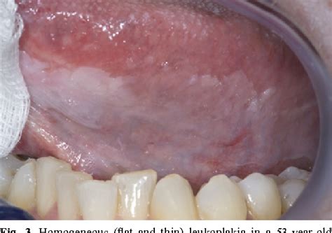 Pdf Oral Leukoplakia The Ongoing Discussion On Definition And