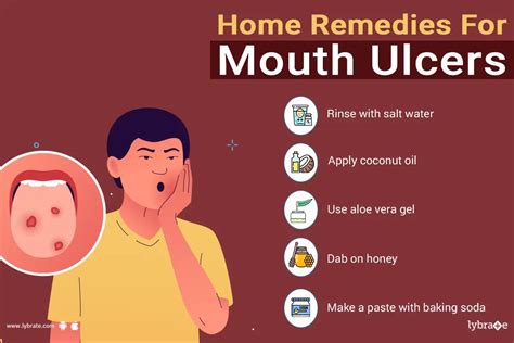 Home Remedies For Mouth Ulcers By Dr Bindiya R Patel Lybrate