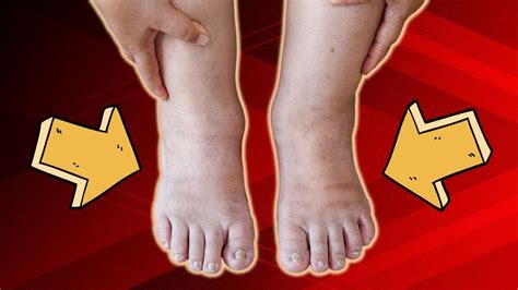 Top Causes Of Ankle Swelling And Pain All You Need To Know Youtube