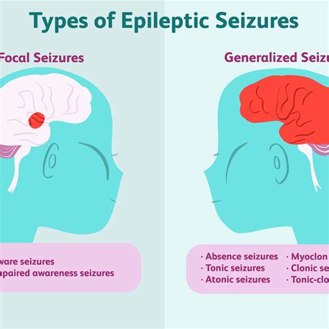 First Class Info About How To Reduce Seizures Springwitness