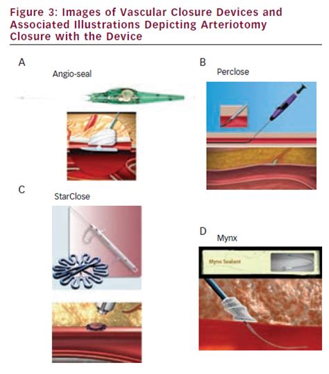Femoral Vascular Access Approaches And Available Devices Icr Journal