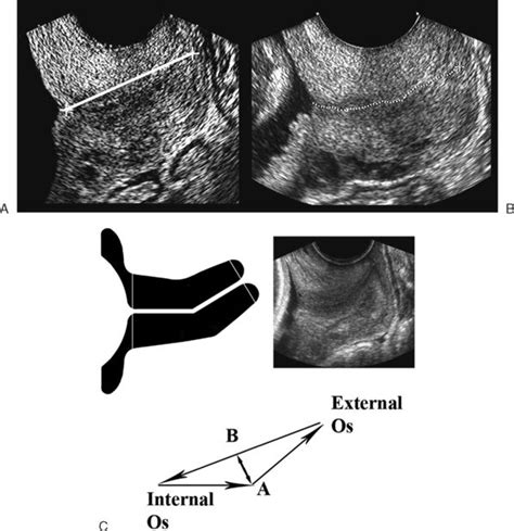 Ultrasound Evaluation Of The Cervix Radiology Key Obstetric Ultrasound Ultrasound