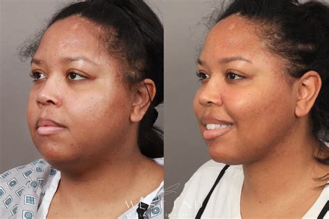Buccal Fat Removal Liposuction And Renuvion Skin Tightening 1 Month