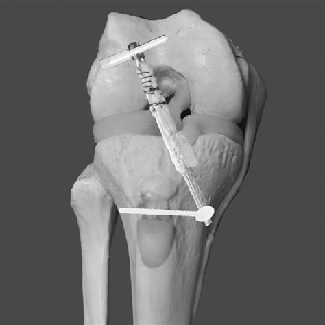 Clinical Results Of Anterior Cruciate Ligament Reconstruction Using