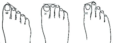 A And B Normal Or Long Big Toe C Mortons Or Short Big Toe C B A