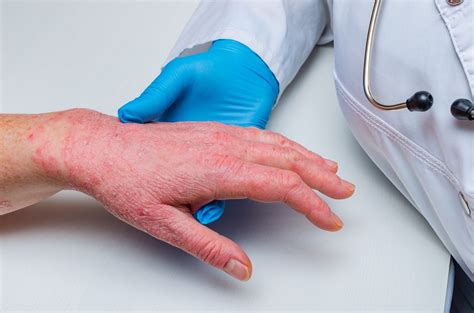 Behçet Disease Associated With Increased Risk For Psoriasis And