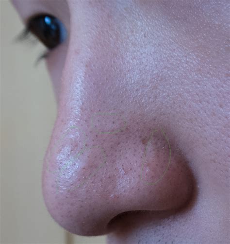 With Pictures Flesh Colored Bumps On Nose Hypertrophic Raised