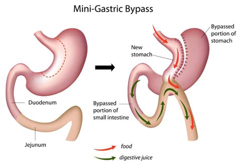 Single Anastomosis Gastric Bypass General Surgery Gold Coast