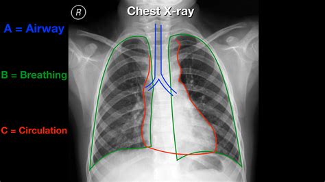 Read And Interpret Chest X Rays The Abcde Mnemonic Step By Step