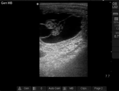 Ultrasonographic Image Of The Presumed Monozygotic Twins At Day 35