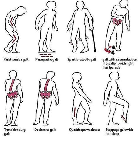 Types Of Gait Physical Therapy Physical Therapy Exercises Physical