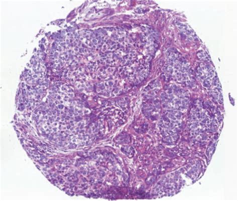P16 Immunostaining Of Hpv Breast Tumors With A Representative