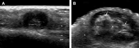 Trichilemmal Cyst A Gray Scale Ultrasound Left Parietal Region Of