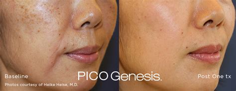 Pico Lasers Skindoc Liverpool Dermatologists Beauty And Skin Treatment